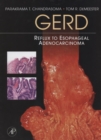 Image for GERD: reflux to esophageal adenocarcinoma