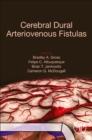 Image for Cerebral dural arteriovenous fistulas