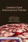 Image for Cerebral Dural Arteriovenous Fistulas