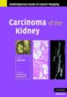 Image for Carcinoma of the kidney