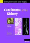 Image for Carcinoma of the kidney