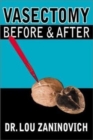 Image for Vasectomy - Before and After