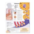 Image for High Cholesterol Anatomical Chart in Spanish (Colesterol Alto)