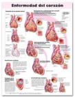 Image for Heart Disease Anatomical Chart in Spanish (Enfermedad del corazon)