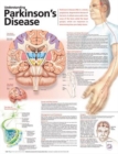 Image for Understanding Parkinson&#39;s Disease Anatomical Chart
