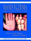 Image for Hand Eczema