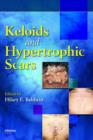 Image for Keloids and Hypertrophic Scars