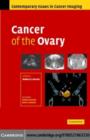 Image for Cancer of the ovary