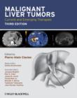 Image for Malignant Liver Tumors
