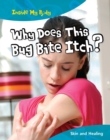 Image for Why does this bite itch?