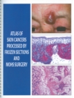 Image for Atlas Of Skin Cancers Processed By Frozen Sections And Mohs Surgery