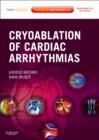 Image for Cryoablation of Cardiac Arrhythmias