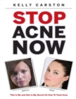 Image for Stop Acne Now: This Is Me and This Is My Secret On How to Treat Acne