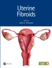 Image for Uterine Fibroids