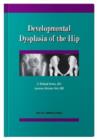 Image for Developmental Dysplasia of the Hip