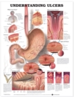 Image for Understanding Ulcers Anatomical Chart
