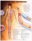 Image for Deep Vein Thrombosis Anatomical Chart