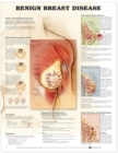 Image for Benign Breast Disease Anatomical Chart