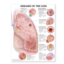 Image for Diseases of the Lung Anatomical Chart