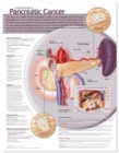 Image for Understanding Pancreatic Cancer Anatomical Chart
