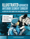 Image for Illustrated advanced anterior segment surgery  : a step-by-step guide for challenging cases