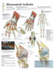 Image for Rheumatoid Arthritis Paper Poster