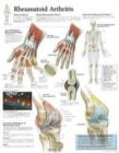 Image for Rheumatoid Arthritis Laminated Poster
