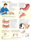 Image for Peptic Ulcer Chart