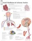 Image for Atrial Fib &amp; Ischemic Strokes Paper Poster