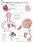 Image for Atrial Fib &amp; Ischemic Strokes Laminated Poster