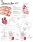 Image for Understanding ACS (Acute Coronary Syndrome) Laminated Poster