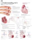 Image for Understanding ACS (Acute Coronary Syndrome) Paper Poster