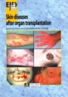 Image for Skin Diseases After Organ Transplantation