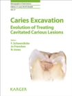 Image for Caries excavation: evolution of treating cavitated caries lesions