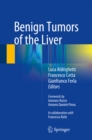 Image for Benign Tumors of the Liver