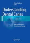 Image for Understanding Dental Caries : From Pathogenesis to Prevention and Therapy