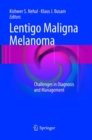 Image for Lentigo Maligna Melanoma
