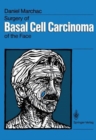 Image for Surgery of Basal Cell Carcinoma of the Face