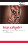 Image for Cuando la tuberculosis afecta otros organos