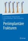 Image for Periimplantare Frakturen