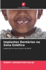 Image for Implantes Dentarios na Zona Estetica