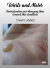 Image for Warts And Moles: Understanding And Managing These Common Skin Conditions