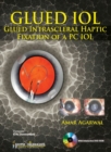 Image for GLUED IOL : Glued Intrascleral Haptic Fixation of a PC IOL