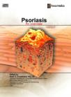 Image for Psoriasis : An Overview