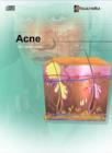 Image for Acne : An Overview