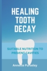 Image for Healing Tooth Decay : Suitable Nutrition to Prevent Cavities