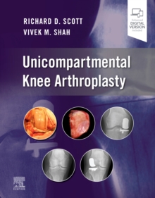 Image for Unicompartmental Knee Arthroplasty