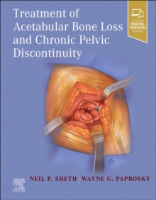 Image for Treatment of Acetabular Bone Loss and Chronic Pelvic Discontinuity