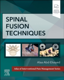 Image for Spinal fusion techniques