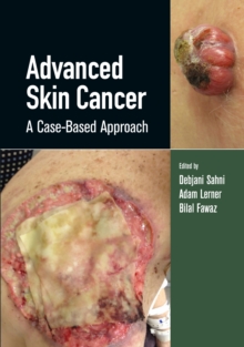 Advanced Skin Cancer: A Case-Based Approach